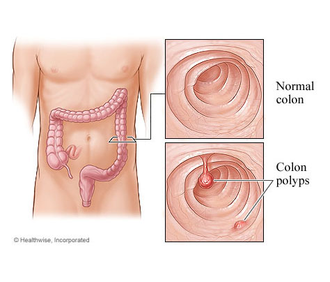 Colon Polyps Buffalo NY