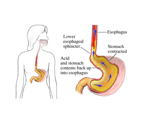 Gastroesophageal Reflux Disease Buffalo NY