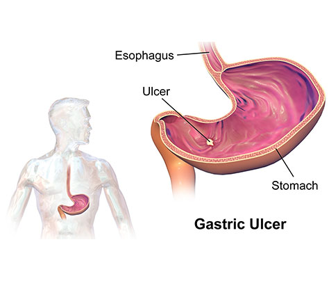 Peptic Ulcer Disease Buffalo NY