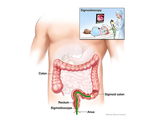 Sigmoidoscopy Buffalo NY