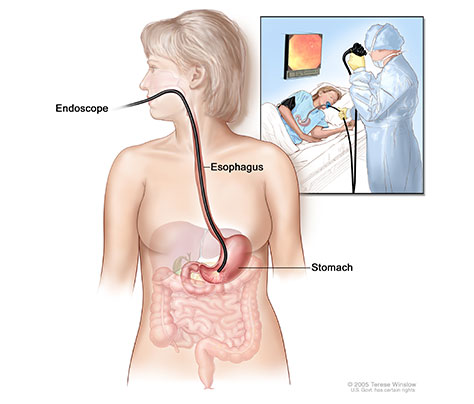 Upper Endoscopy Buffalo NY