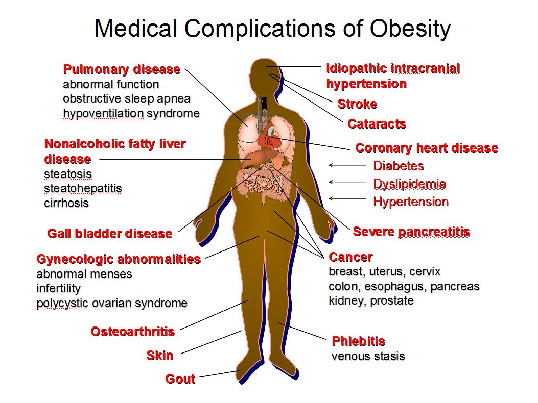 Obesity Buffalo NY